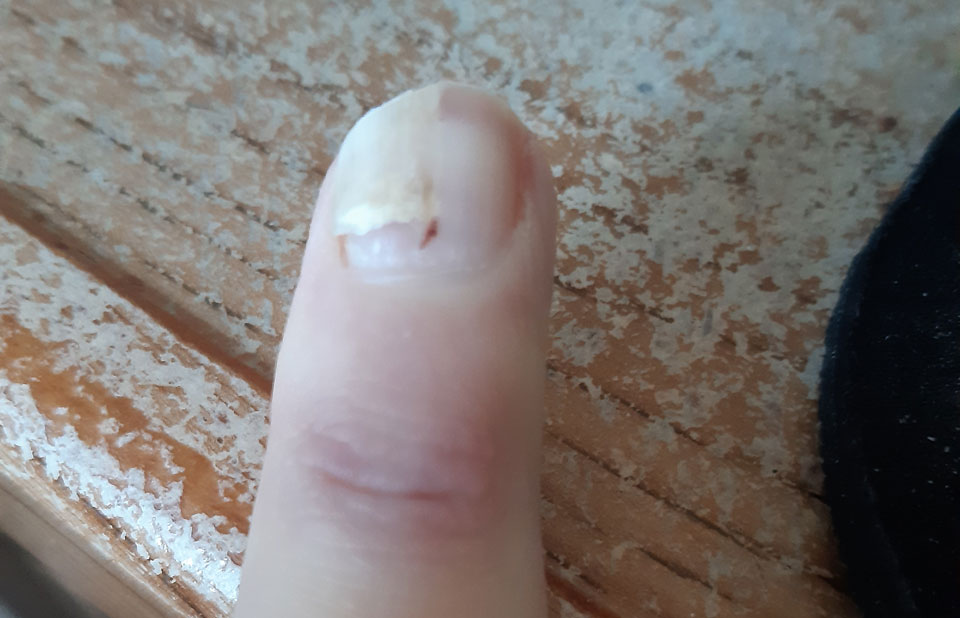 L'ongle avec le quadrant haut-gauche blanchi et une petite ligne légèrement verticale rouge en dessous